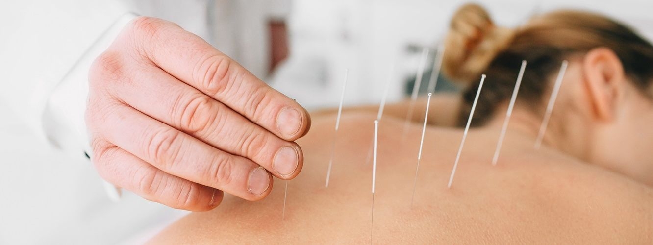 General accupuncture image