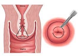 Cervical conization image
