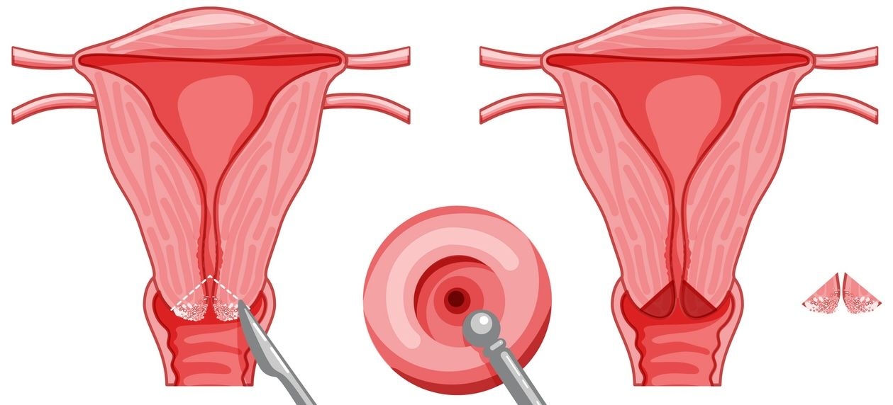 Cervical conization image
