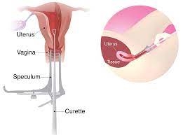 Dilation and Curettage (D&C) - Diagnostic and Therapeutic image