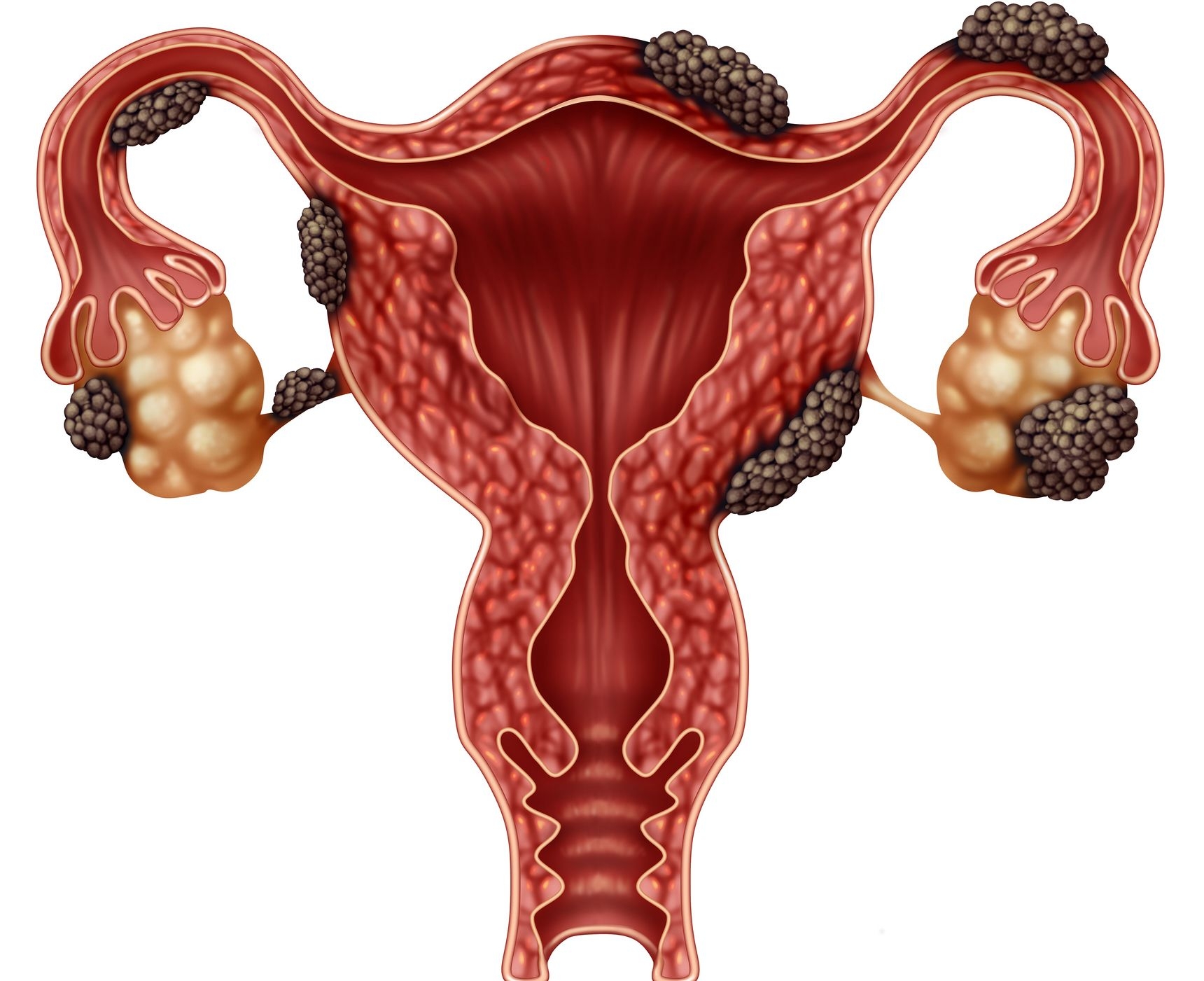 Endometriosis image