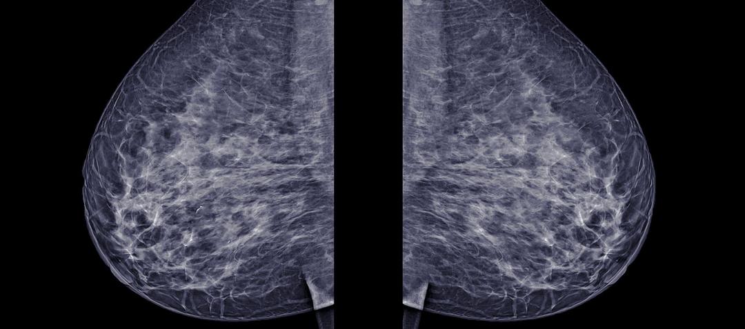 breast cancer long.jpg